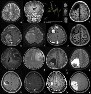 The Survival and Prognostic Factors of Supratentorial Cortical Ependymomas: A Retrospective Cohort Study and Literature-Based Analysis